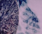 tuberculosis