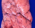 lung in asthma