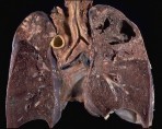 tuberculosis