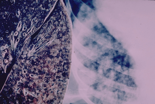 How has TB come to be in Africa? - Tuberculosis
